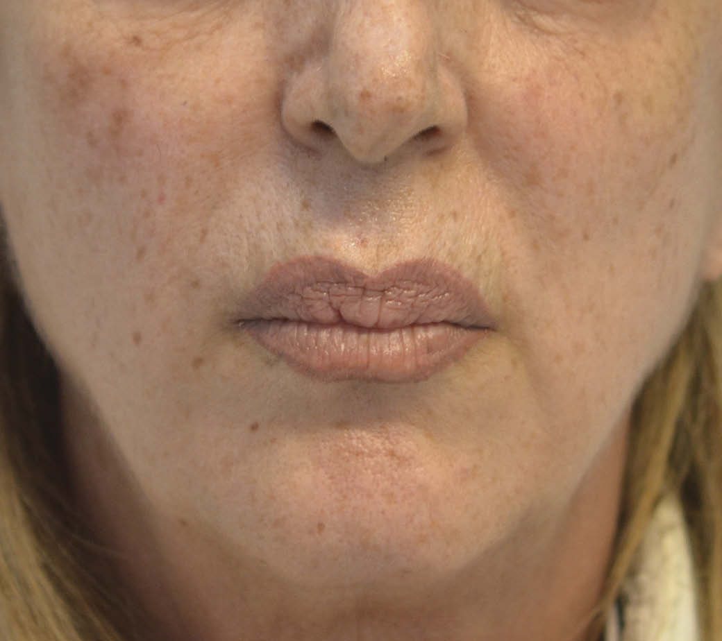 62歲女性口周皺紋治療前照片