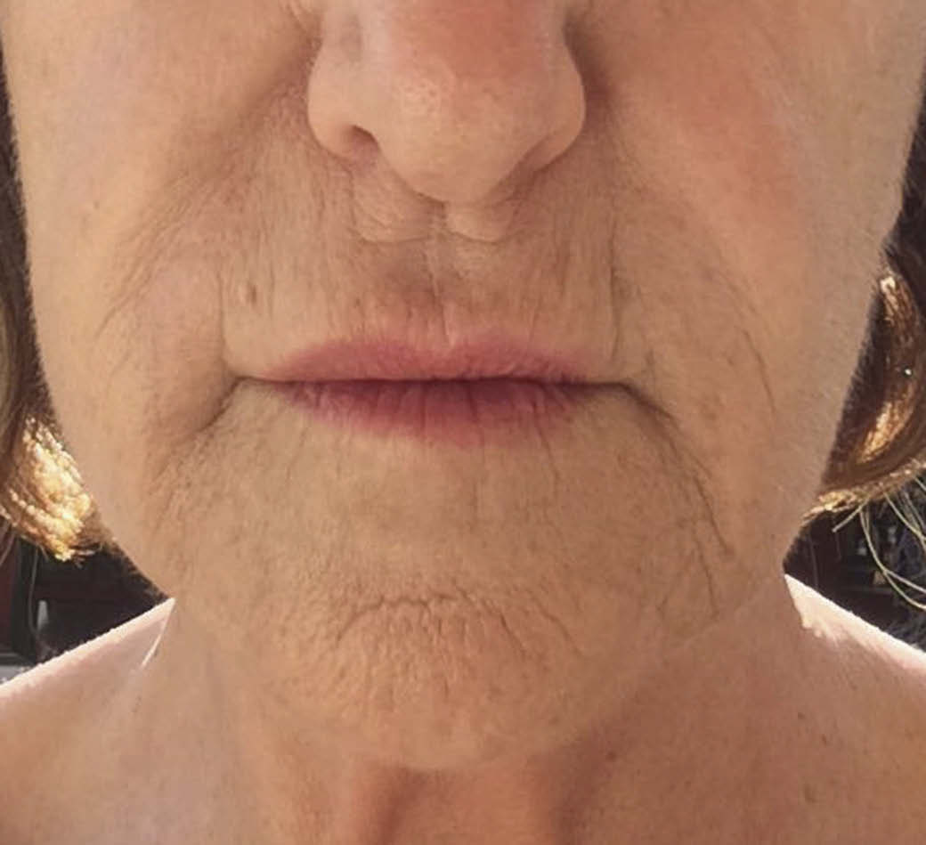 62歲女性外用PRP治療6個月後照片