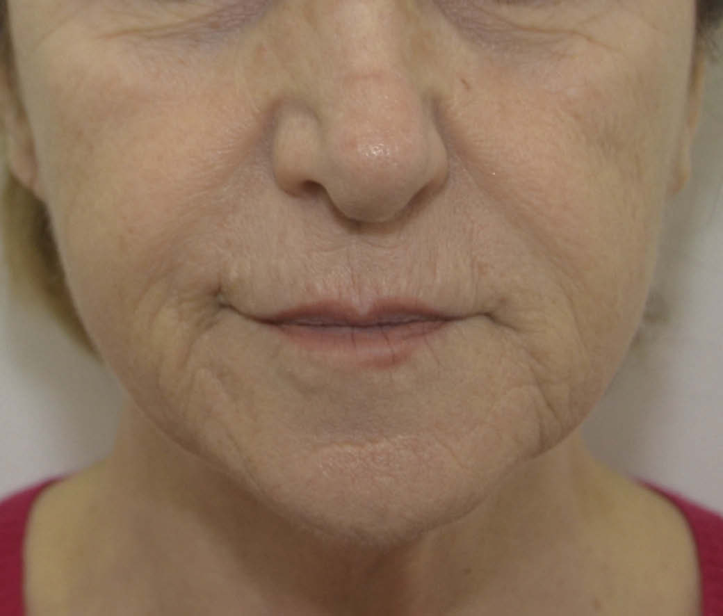 60歲女性口周皺紋治療前照片