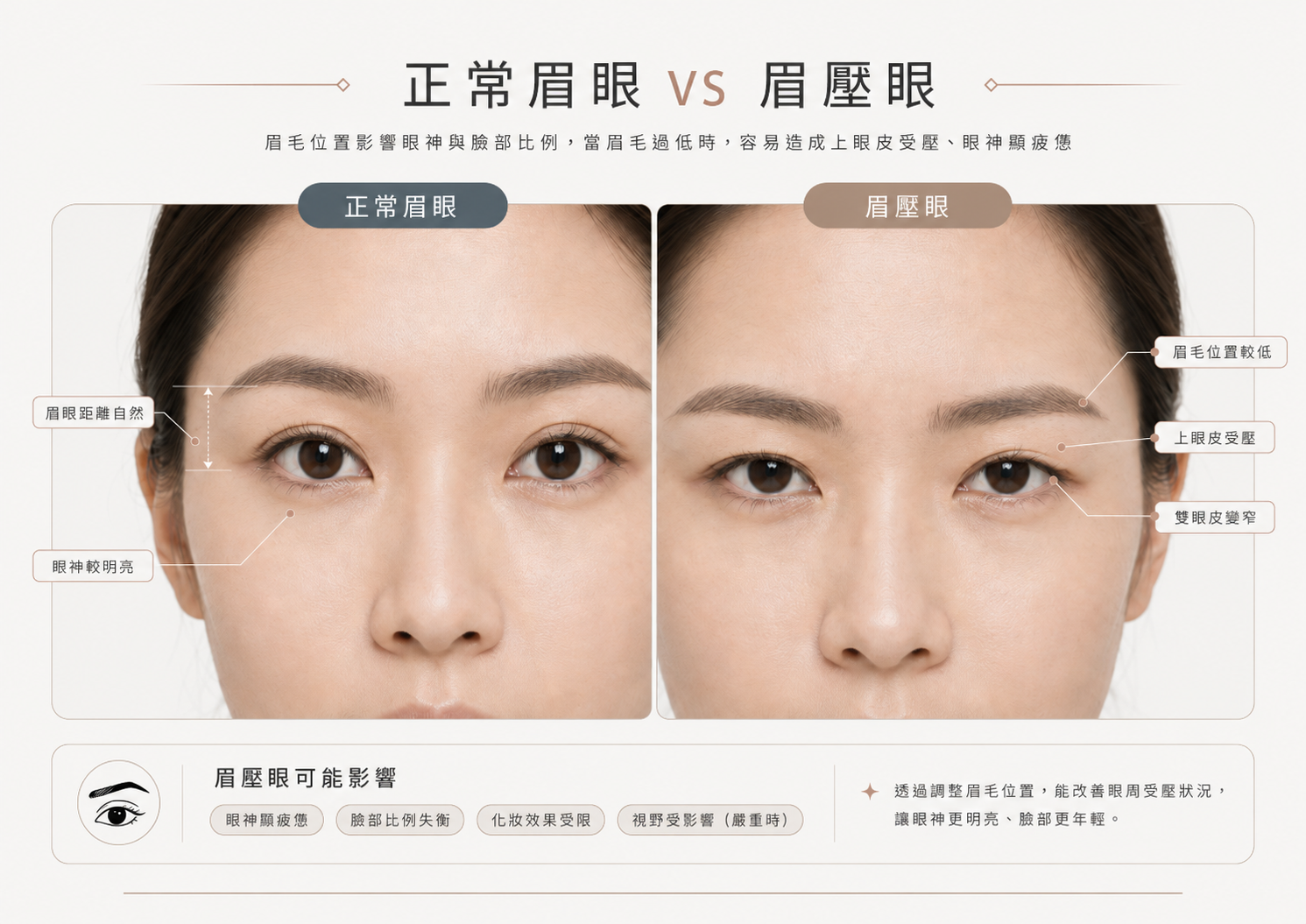 正常眉眼與眉壓眼比較圖，顯示眉毛位置下降造成上眼皮受壓與雙眼皮變窄