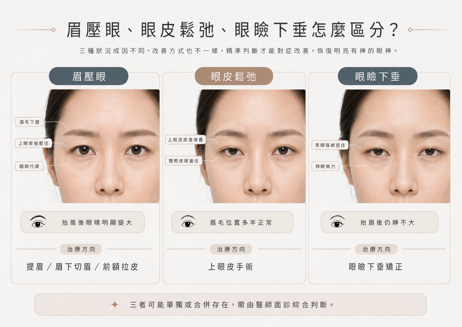 眉壓眼眼皮鬆弛眼瞼下垂三者比較圖，說明主要位置、常見表現與治療方向