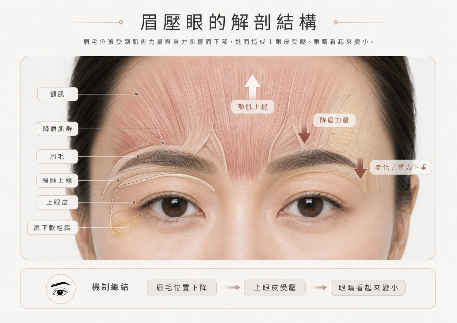 眉壓眼解剖結構圖，標示額肌降眉肌群眉毛眼眶上緣上眼皮與眉下軟組織