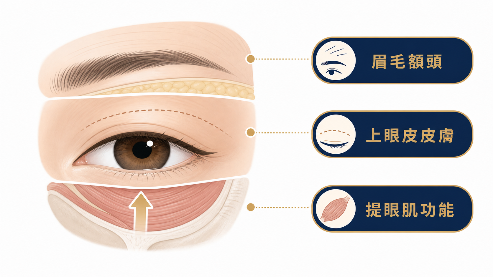 眉毛眼皮提眼肌三層結構示意圖:說明眼皮下垂可能來自不同層次
