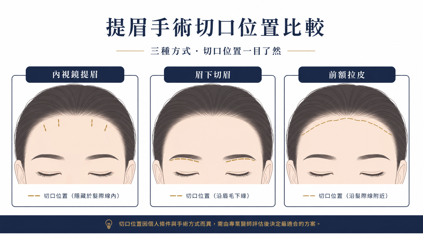 內視鏡提眉、眉下切眉與前額拉皮切口位置比較示意圖