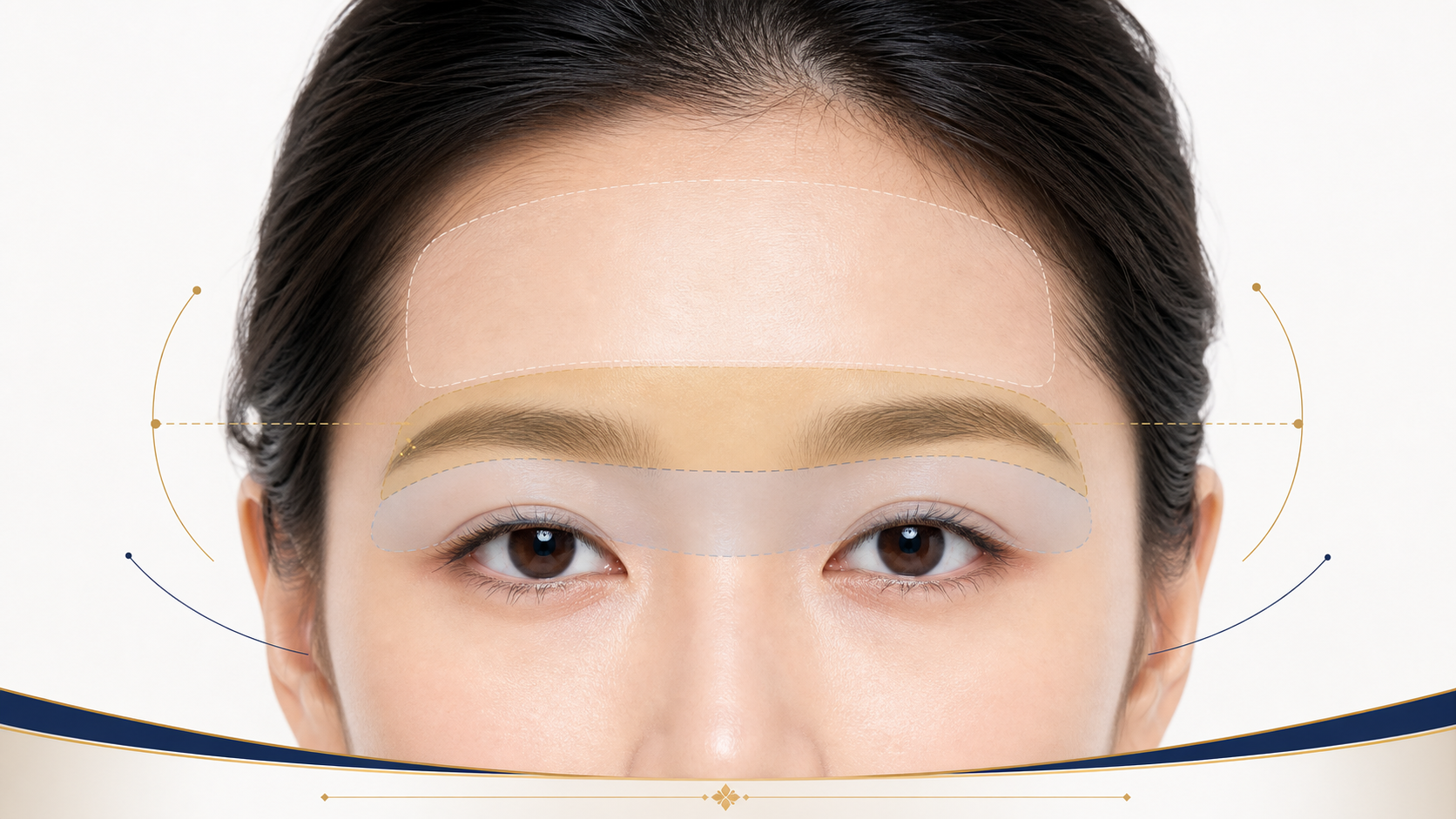 眉壓眼三層來源示意圖,擬真標示前額、眉毛位置與上眼皮皮膚如何共同影響術式選擇