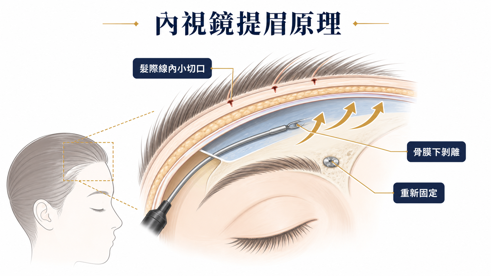 內視鏡提眉手術原理示意圖：髮際線小切口、骨膜下剝離與固定位置