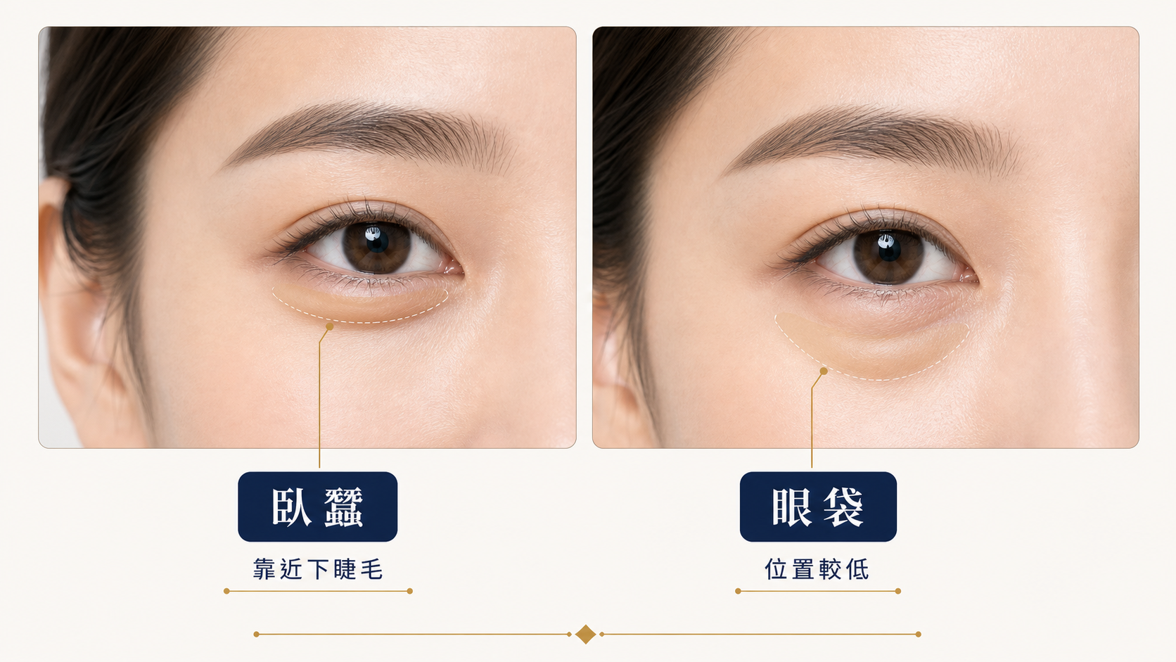 臥蠶與眼袋擬真對照圖，顯示臥蠶靠近下睫毛而眼袋位置較低