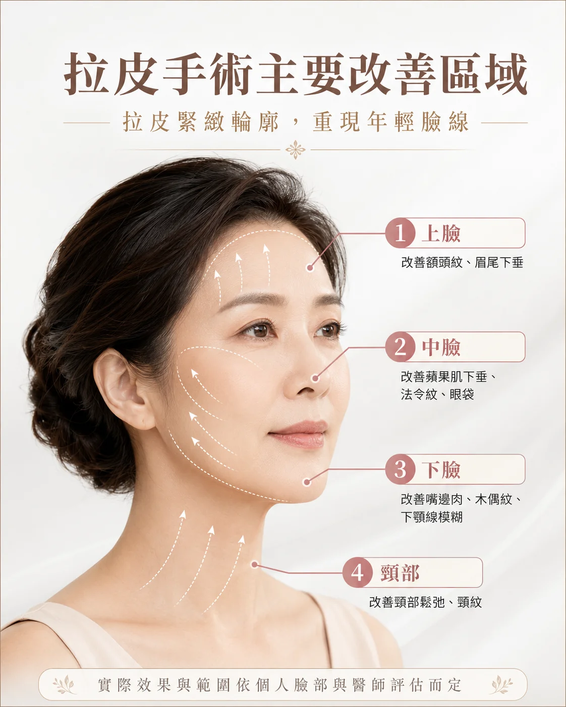 拉皮手術主要改善區域示意圖：上臉、中臉、下臉、頸部四大區域標註
