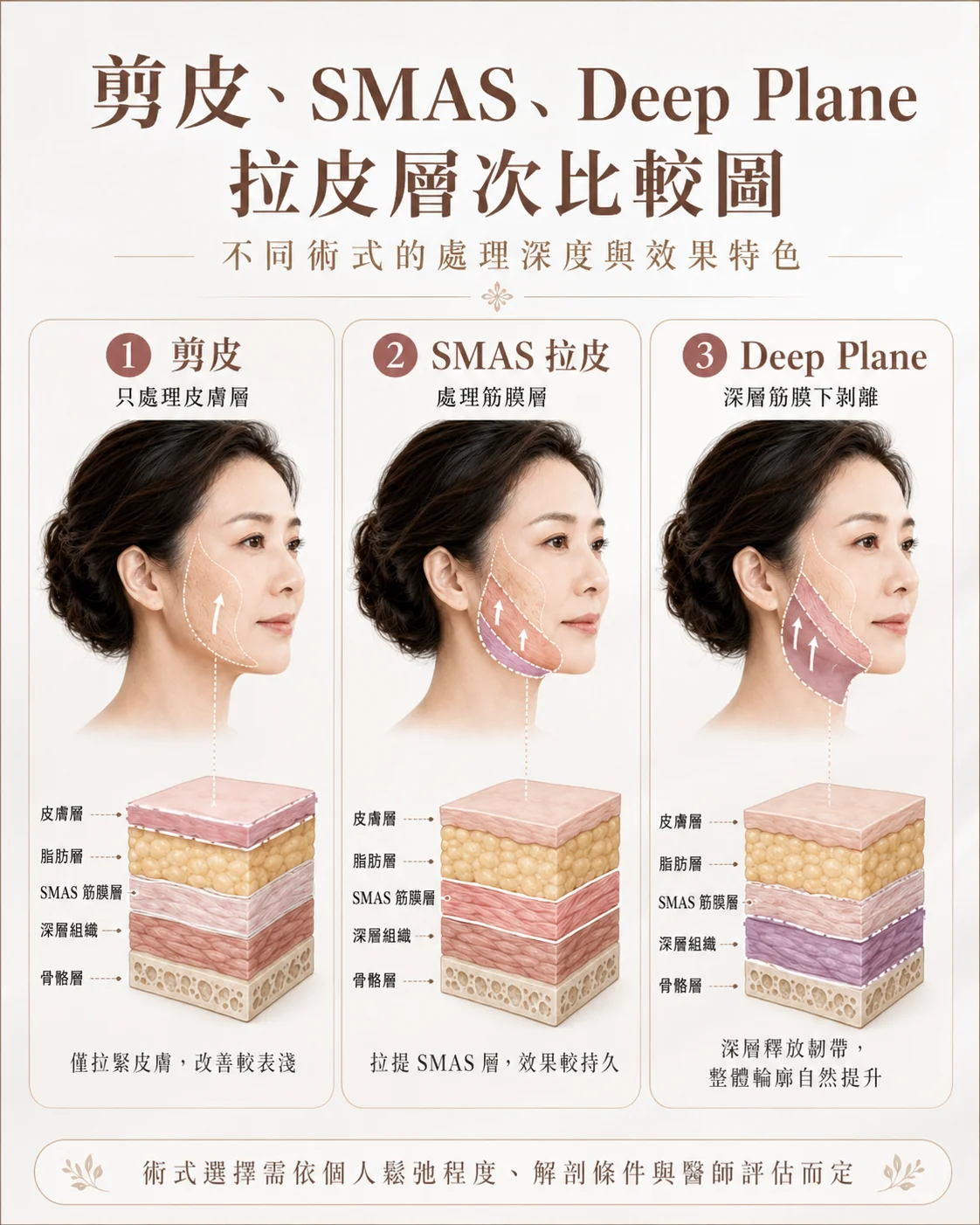 三種拉皮術式層次比較：剪皮僅處理皮膚層、SMAS拉皮處理筋膜層、Deep Plane深層筋膜下剝離