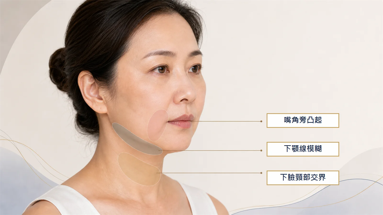 嘴邊肉位置示意圖，標示嘴角旁凸起、下顎線模糊與下臉頸部交界