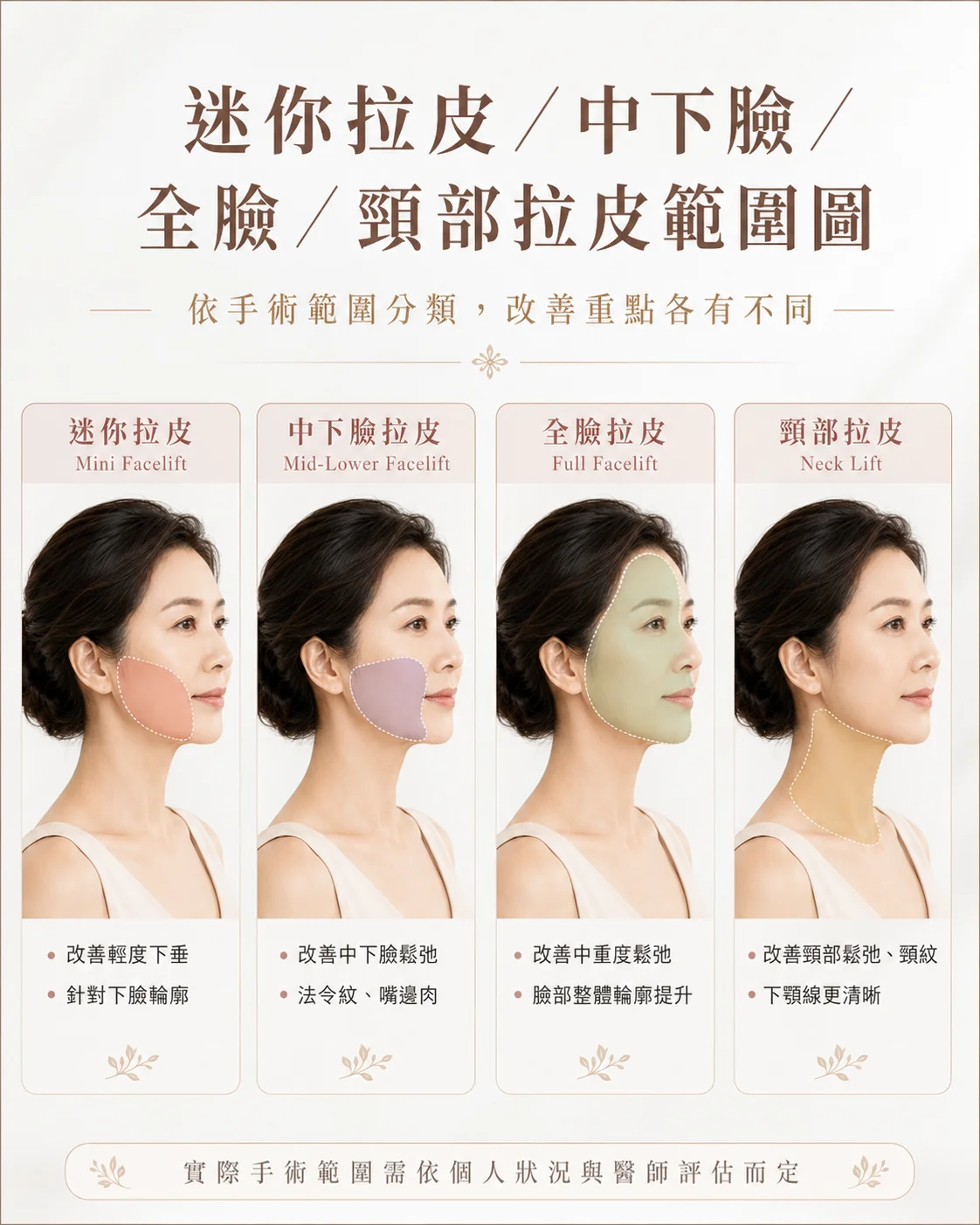 四種拉皮手術範圍比較：迷你拉皮、中下臉拉皮、全臉拉皮、頸部拉皮各自涵蓋的臉部區域