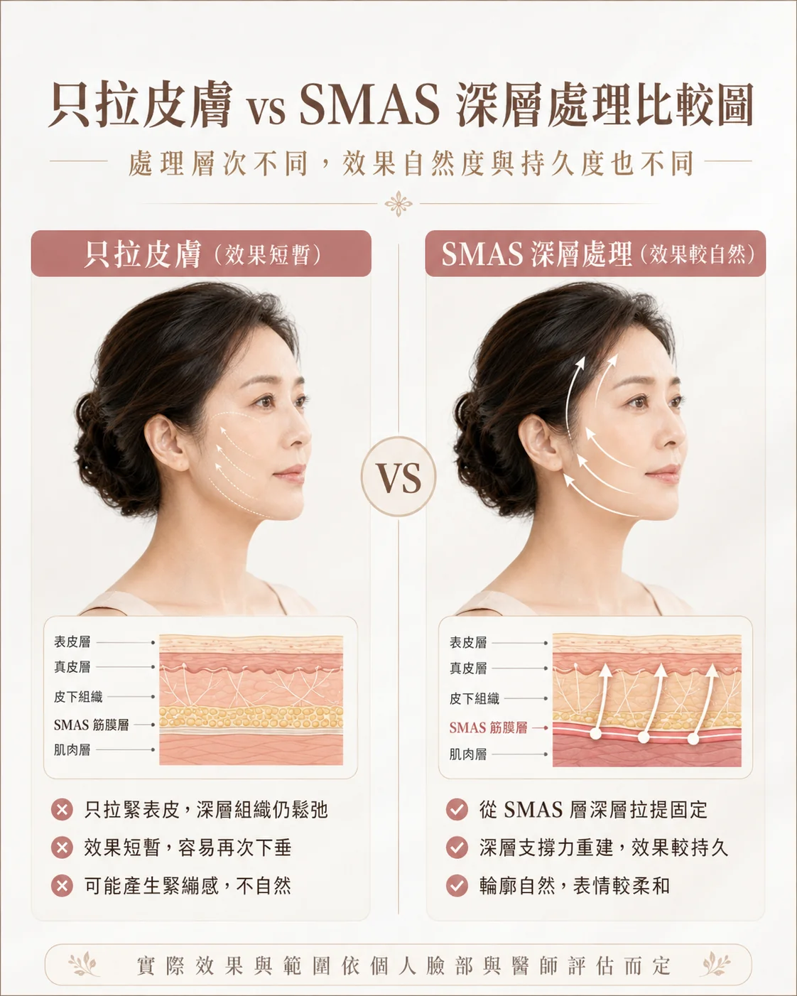 只拉皮膚與SMAS深層處理比較圖：左側只拉表皮效果短暫，右側SMAS深層處理效果較自然持久