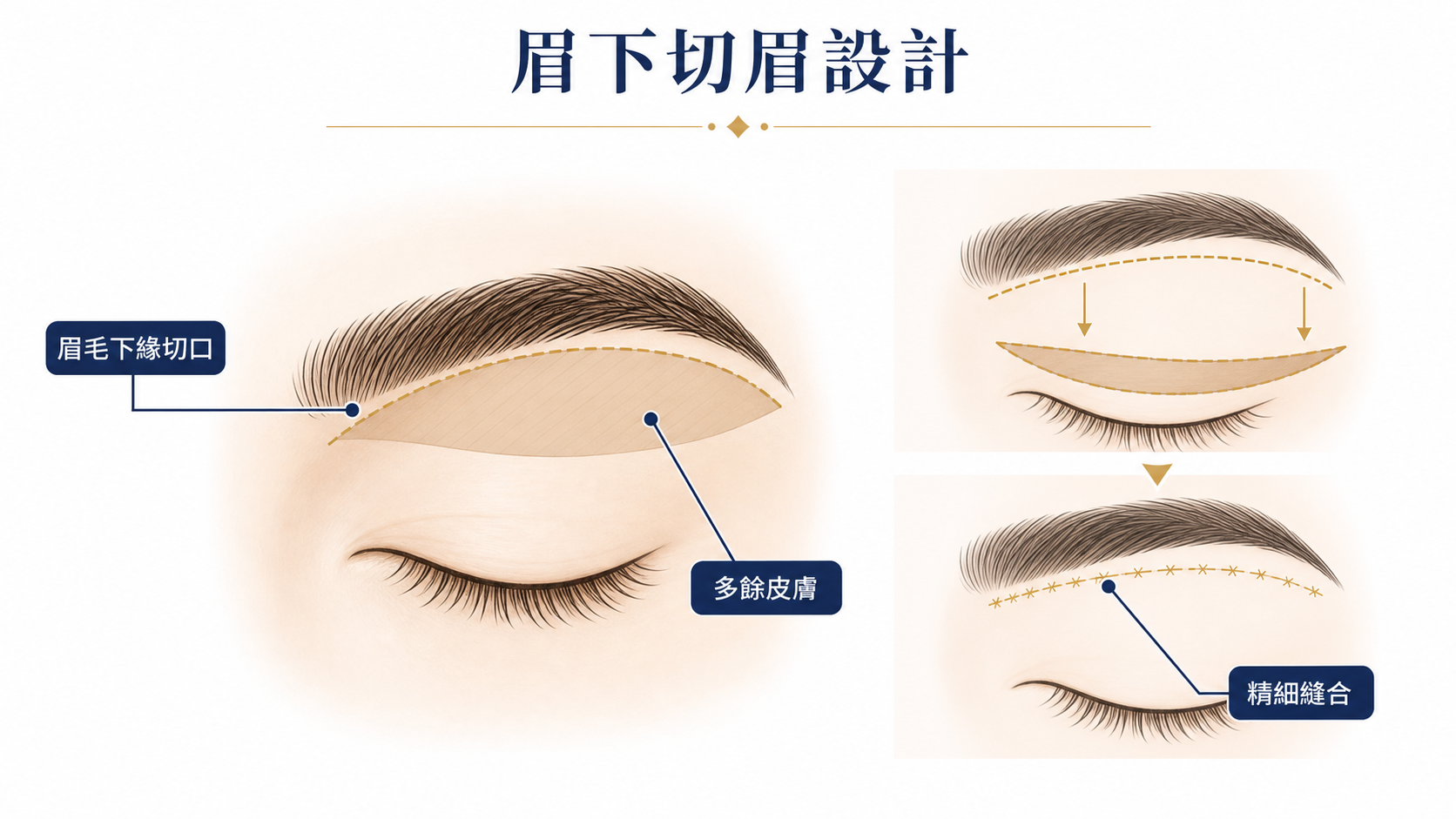 眉下切眉手術設計示意圖：沿眉毛下緣切除多餘上眼皮皮膚