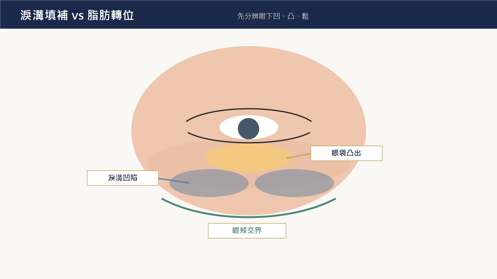 淚溝填補與眼袋脂肪轉位前的眼下凹陷凸起位置示意圖