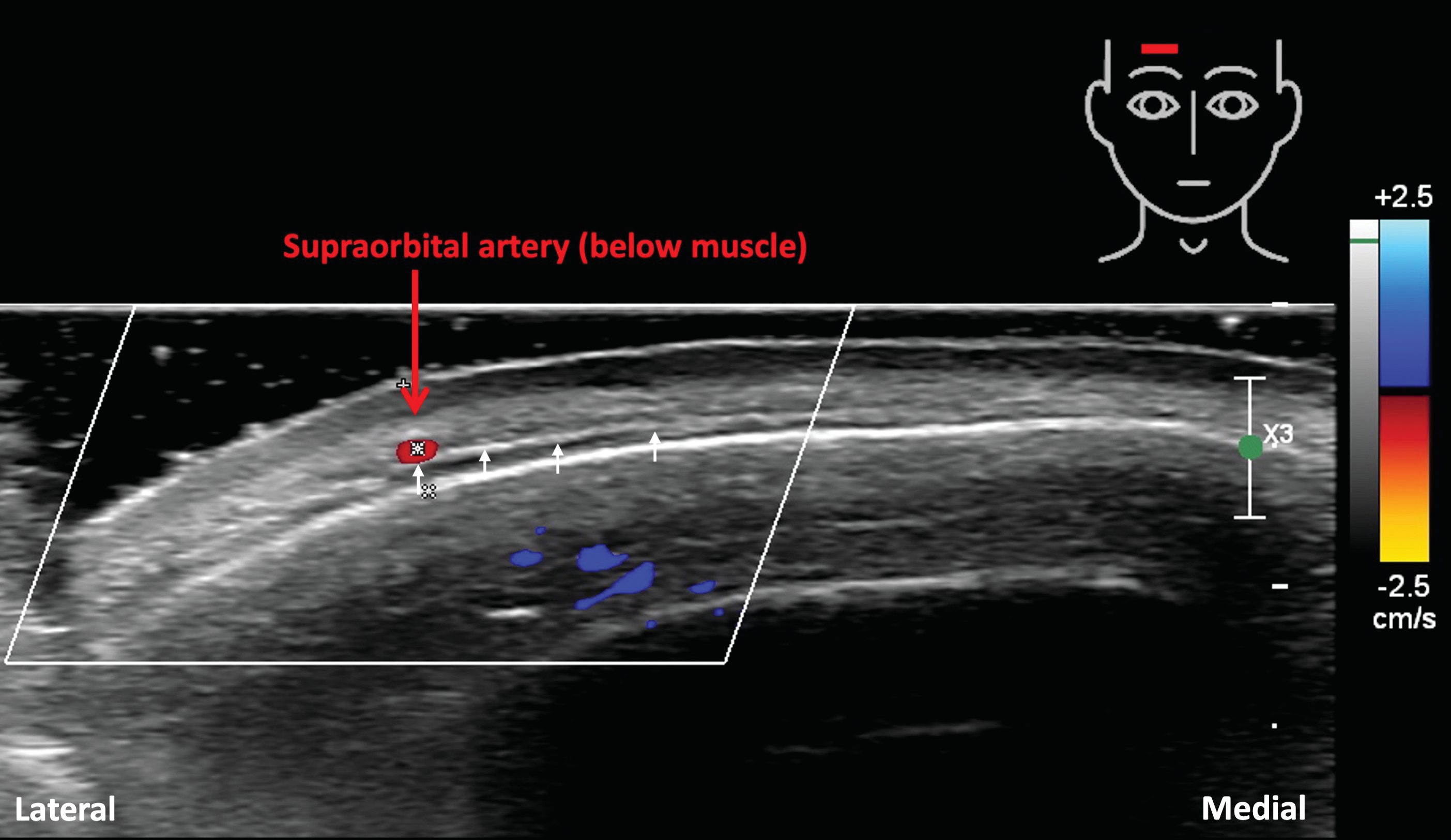 論文圖片：超音波顯示眶上動脈位置（1160）