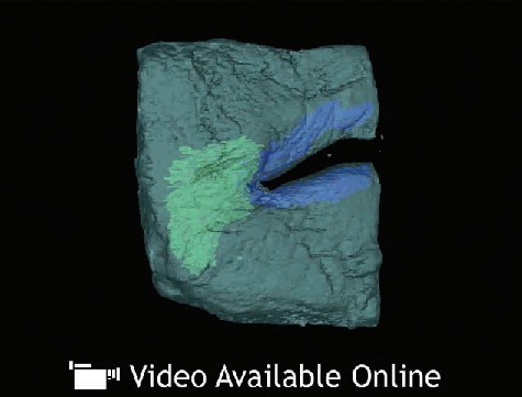 3D骨骼模型，顯示骨折及修復過程。｜127-BR