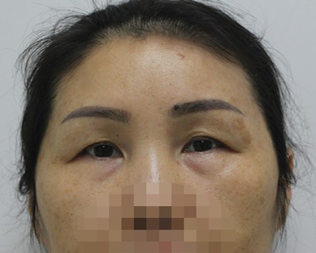 眼部周圍有色素沉著和浮腫現象。|1368
