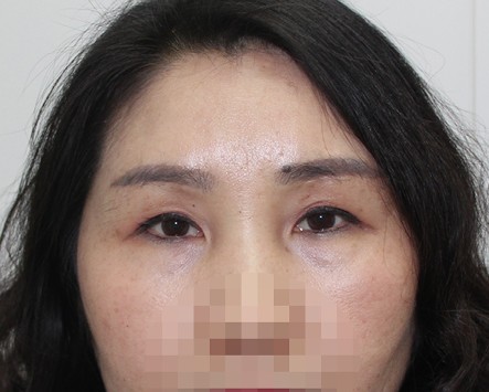 女性眼部整形術後恢復狀況。|1368