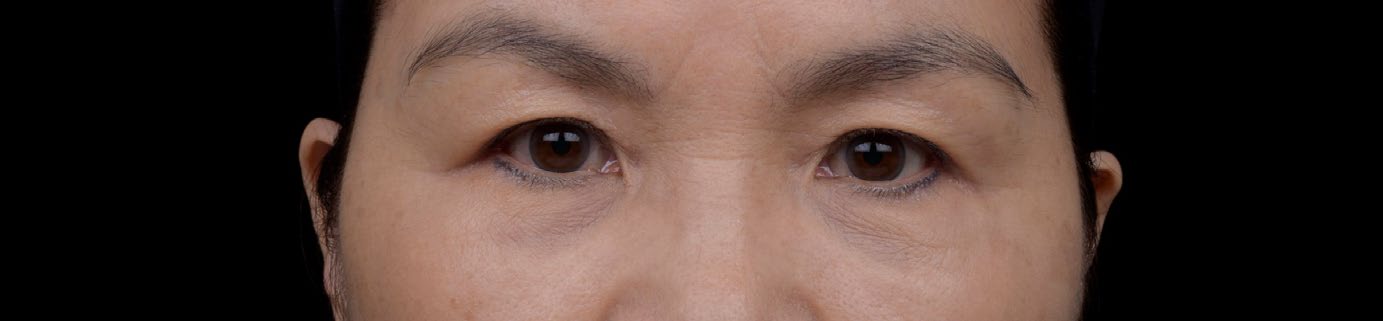 案例一：注射後1個月