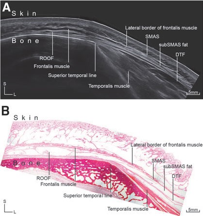 頭部橫切面圖，顯示皮膚、肌肉及脂肪層結構。｜672