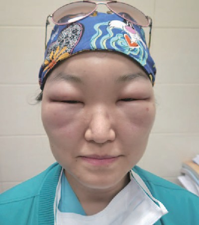 眼睛腫脹,戴著印花頭巾和眼鏡。|951
