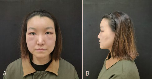 女子面部腫脹,正面與側面對比。|951
